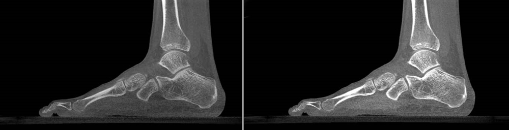 Image comparing the results of Curvebeam's original technology (left) to that using IBEX Trueview